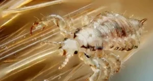 Can Black People Get Lice in Their Hair?